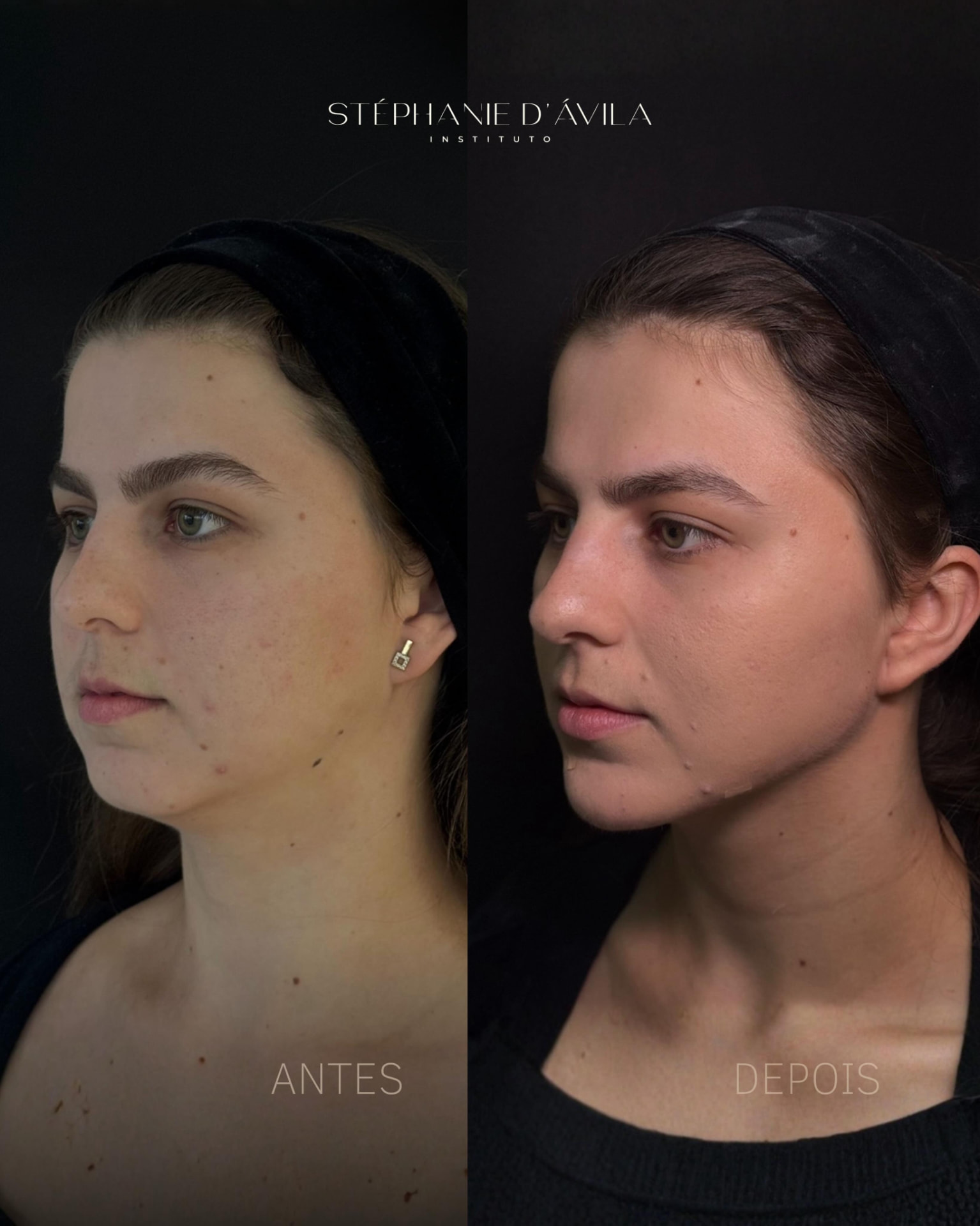Antes e depois de definição de mandíbula e mento feminino