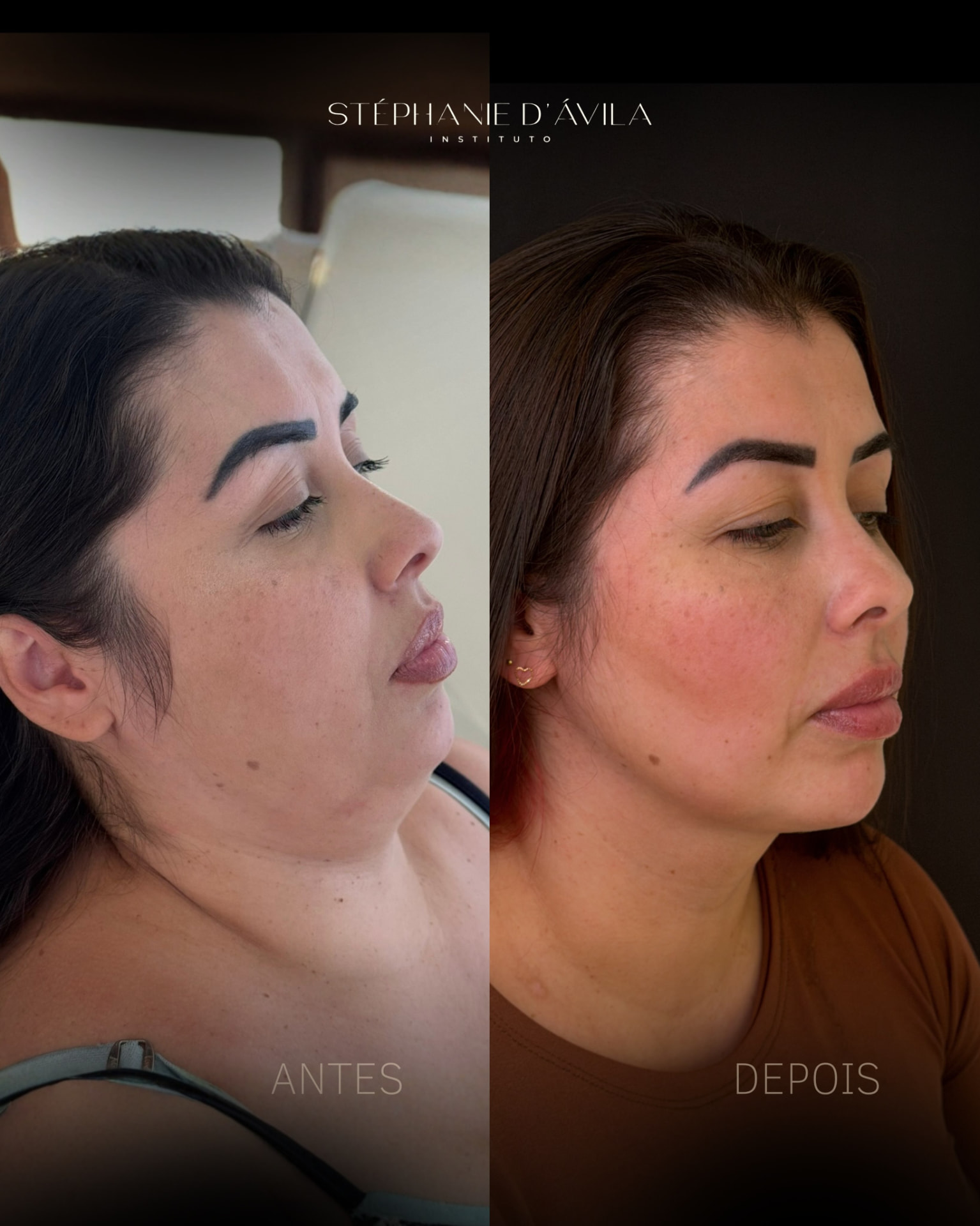 Antes e depois de definição de contorno facial e papada