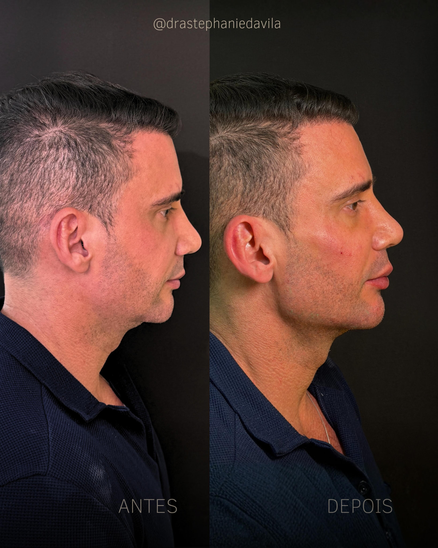 Antes e depois de Full Face masculino com projeção de mento