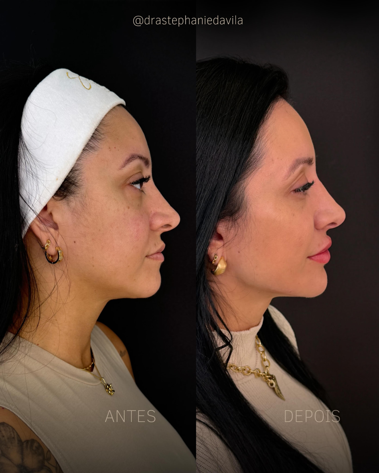Antes e depois de harmonização facial feminina em perfil
