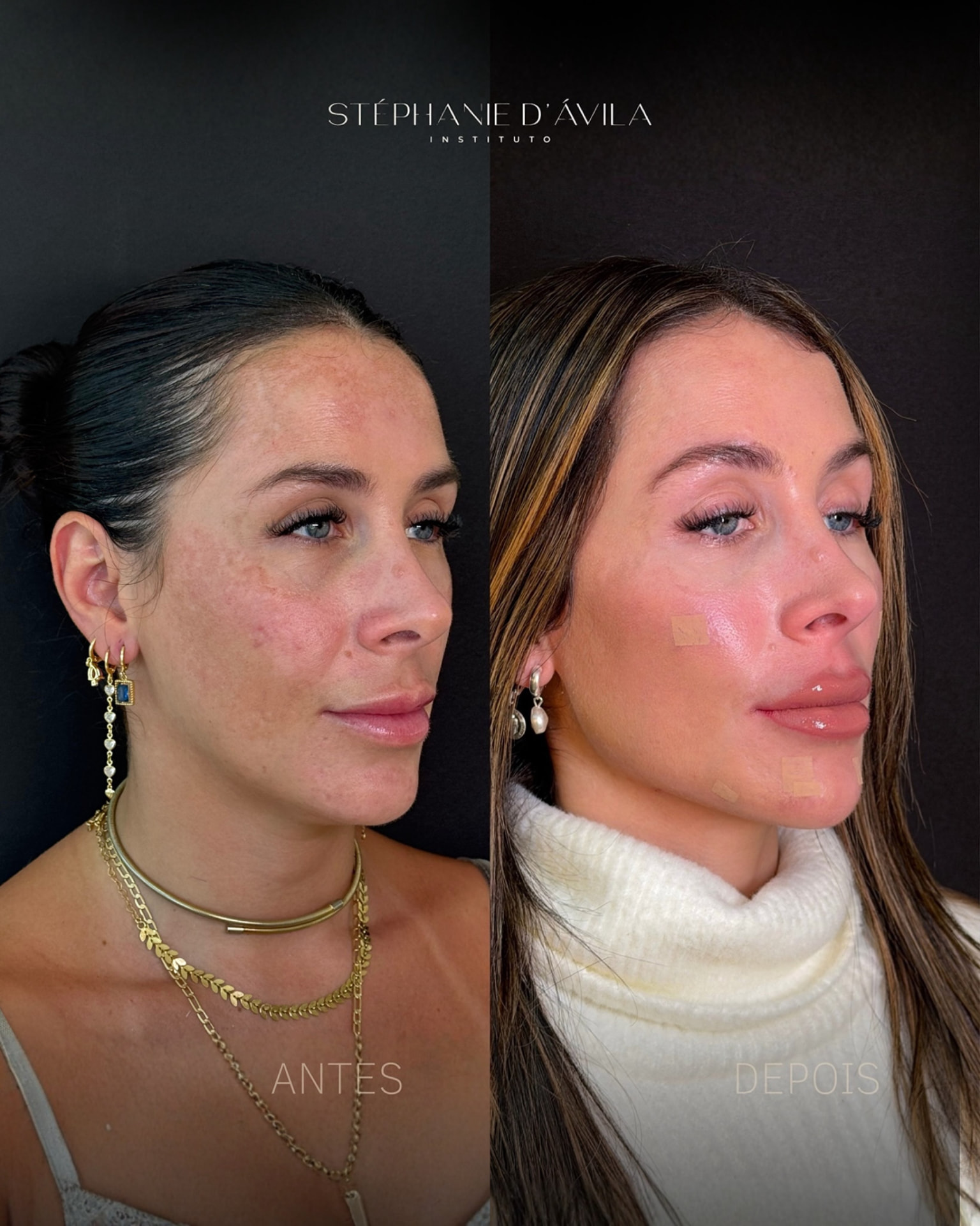 Antes e depois de harmonização facial com preenchimento labial