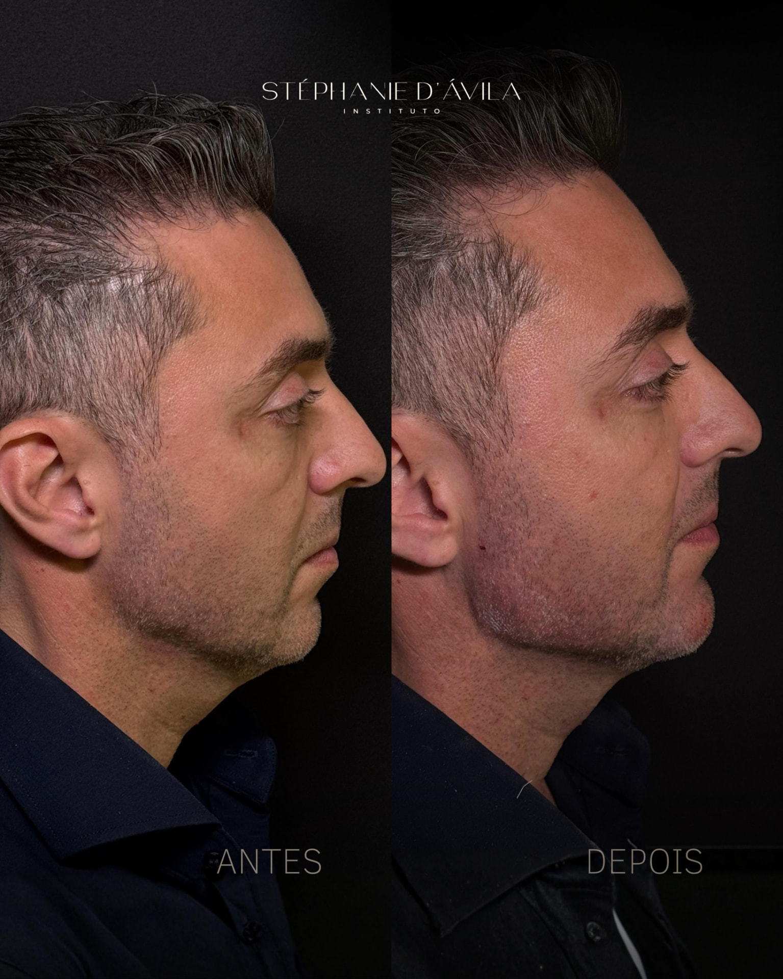 Antes e depois de Full Face masculino em perfil
